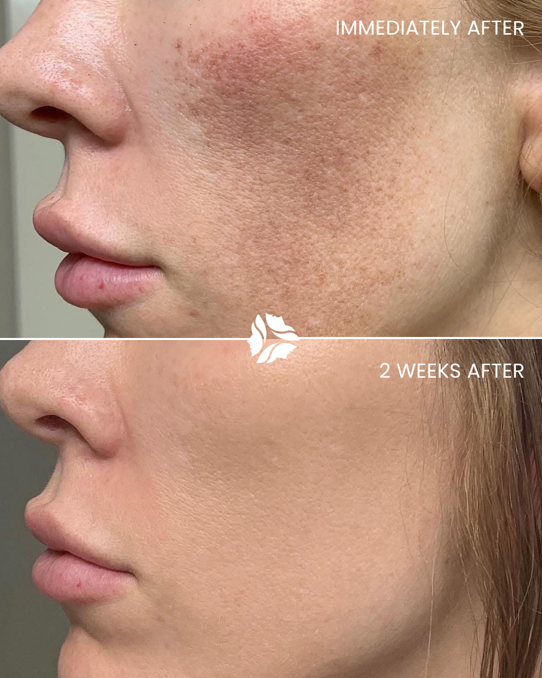 Laser treatment by Williamson Cosmetic Center & Perenack Aesthetic Surgery