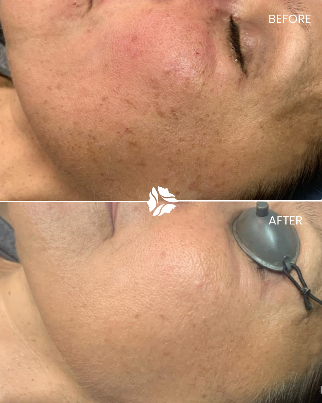 IPL treatment by Williamson Cosmetic Center & Perenack Aesthetic Surgery in Louisiana