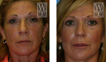 Before and after photos of a woman's face, showing a cosmetic procedure's effect: smoother skin and reduced wrinkles.
