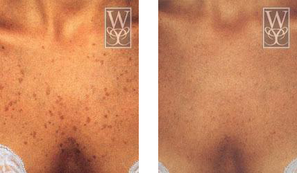 Before and after photos of skin with spots, then clear, with a logo in the top corner.