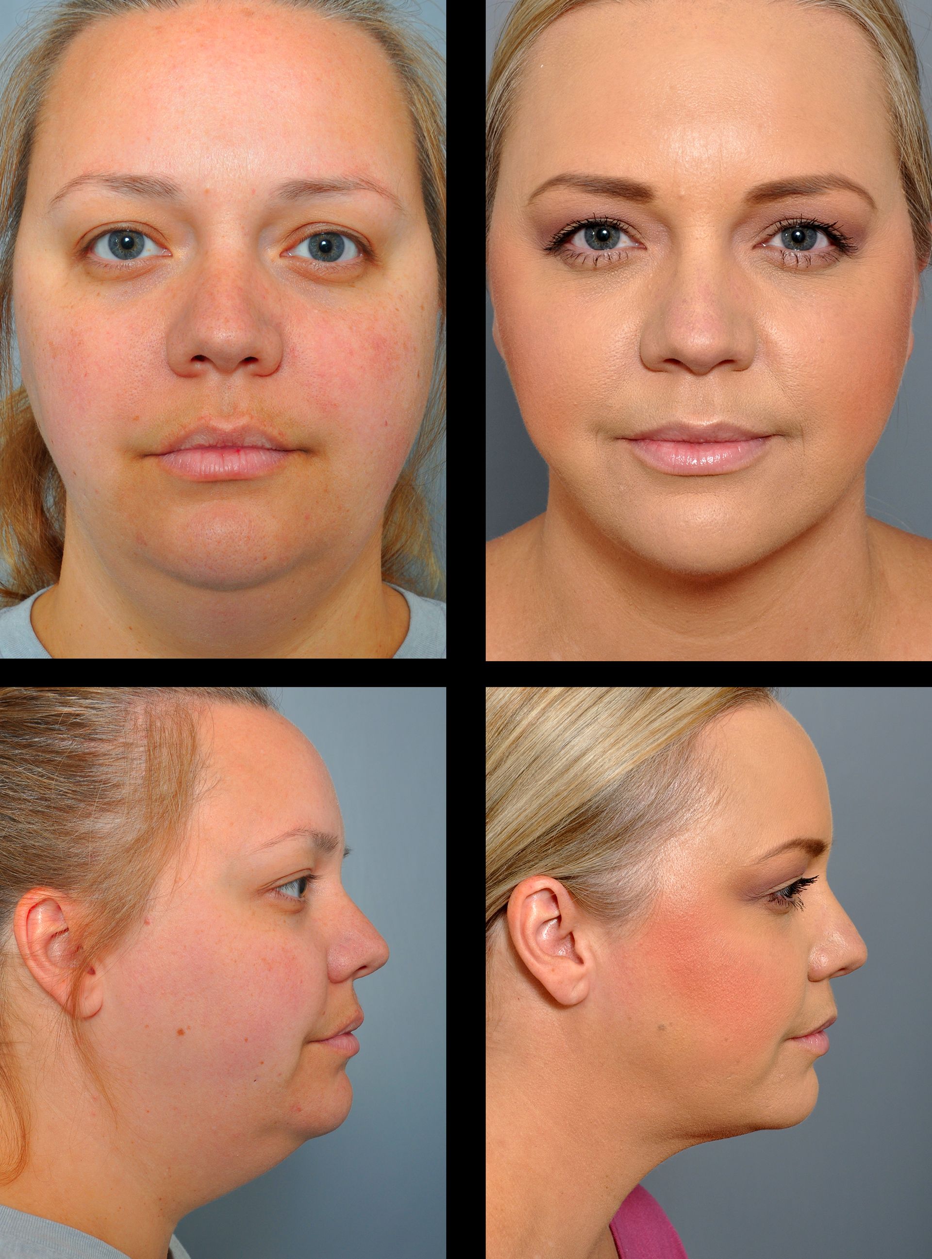 before and after facial liposuction and morpheus8