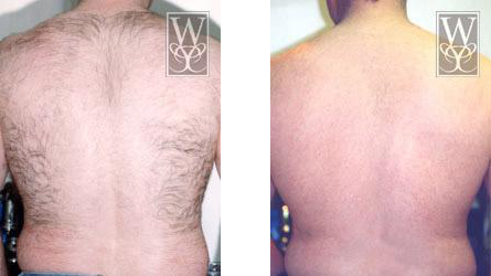 Before and after comparison of a back with hair (left) and hair removal (right).