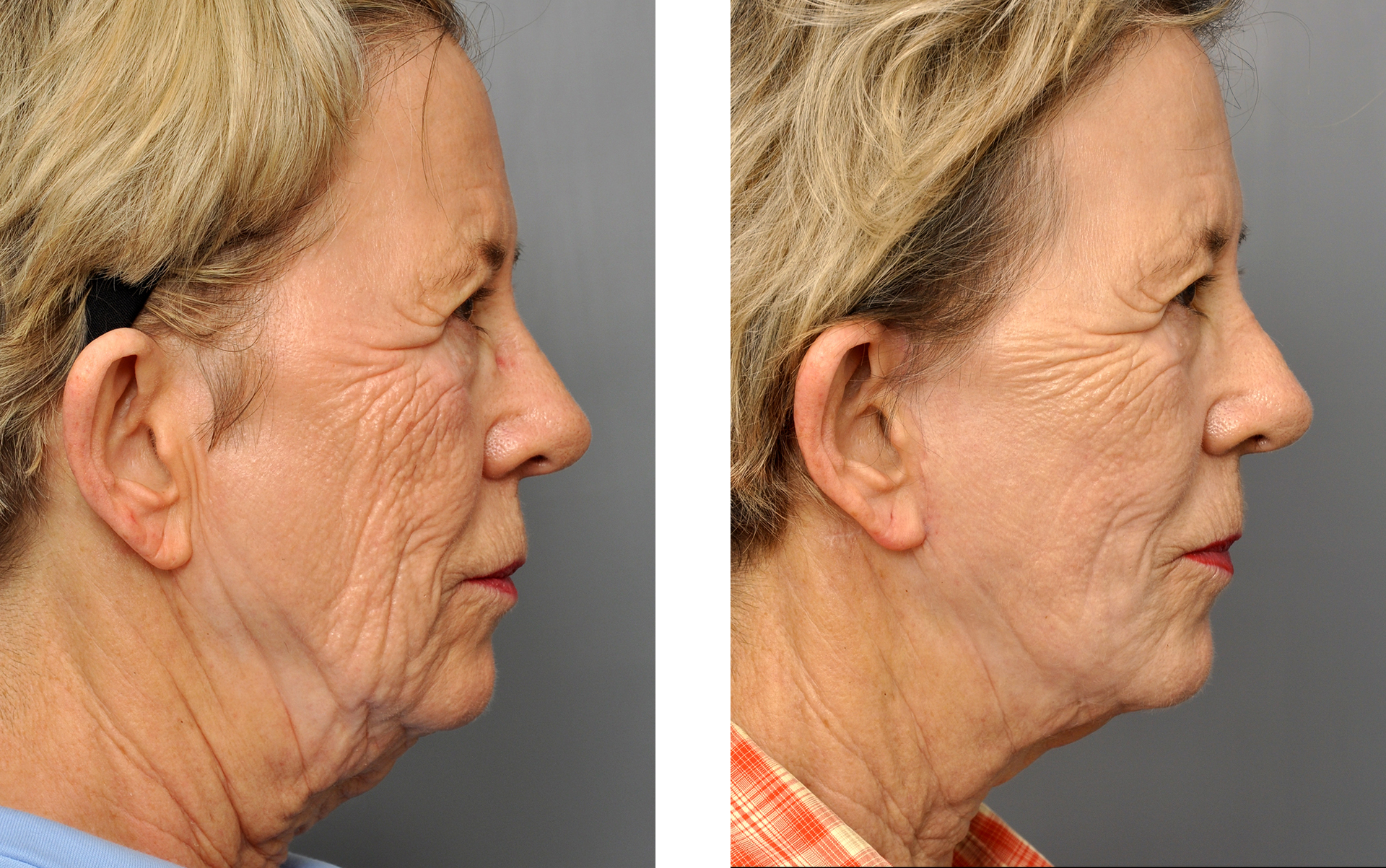 Side-by-side comparison: woman's face before and after a facelift. Skin appears smoother, with less sagging.