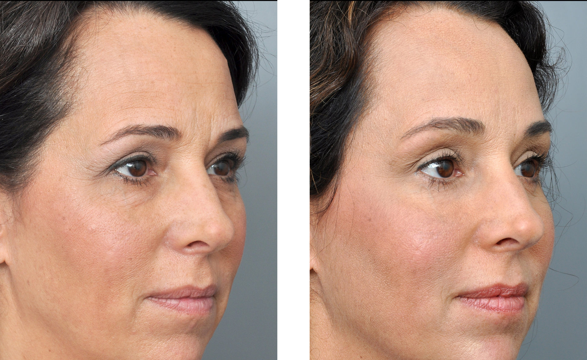 Before and after images of a woman's face, showing reduction of wrinkles, with improved skin tone.