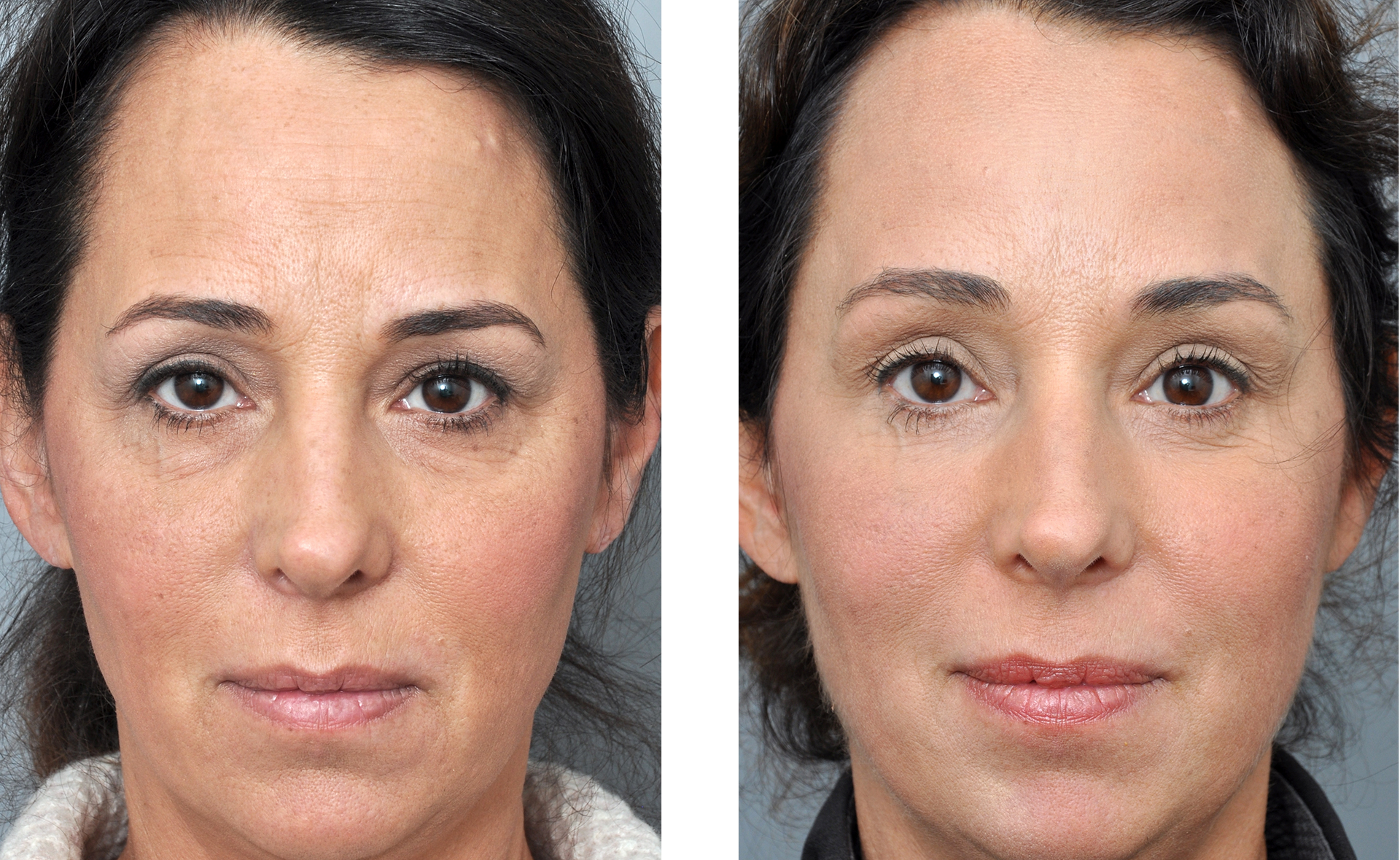 Comparison of a woman's face before and after a cosmetic procedure, showing reduced wrinkles and smoother skin.