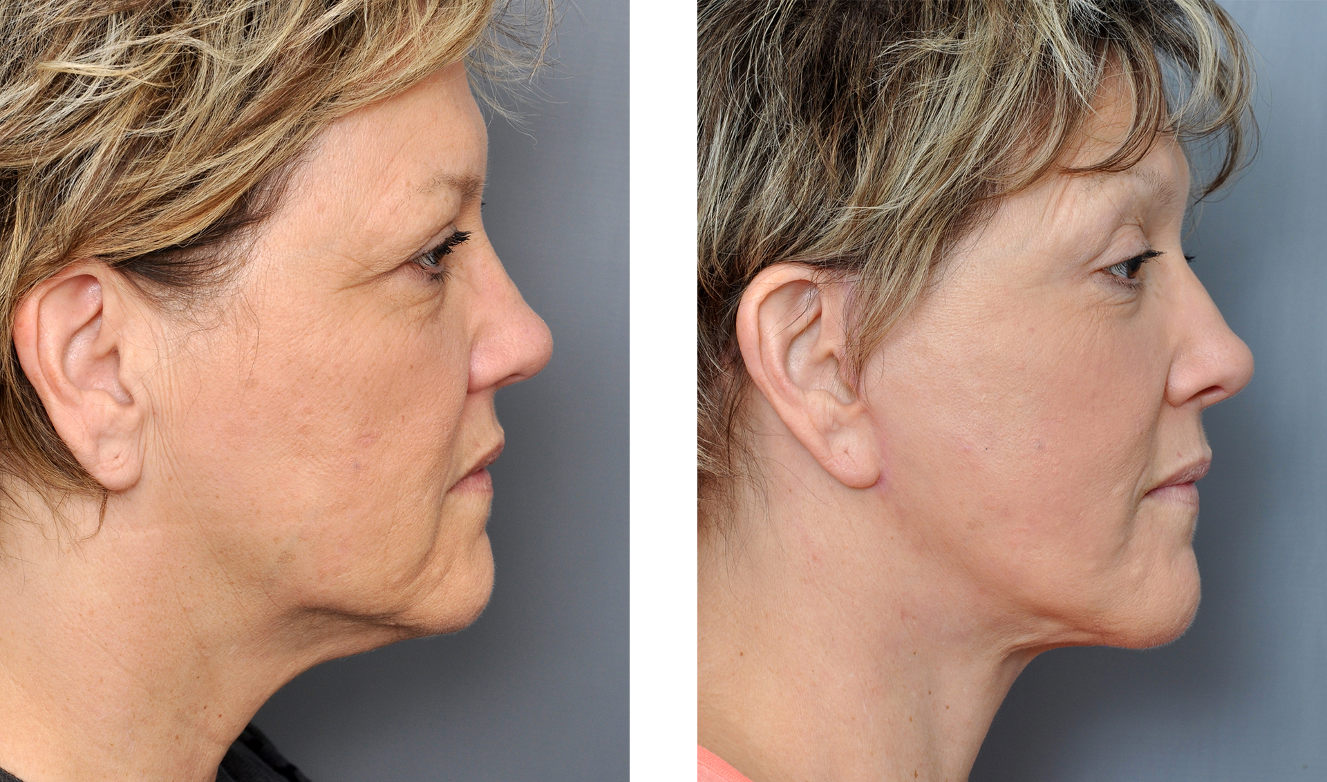 Before-and-after of a woman's profile, showing a smoother jawline and neck after cosmetic surgery.
