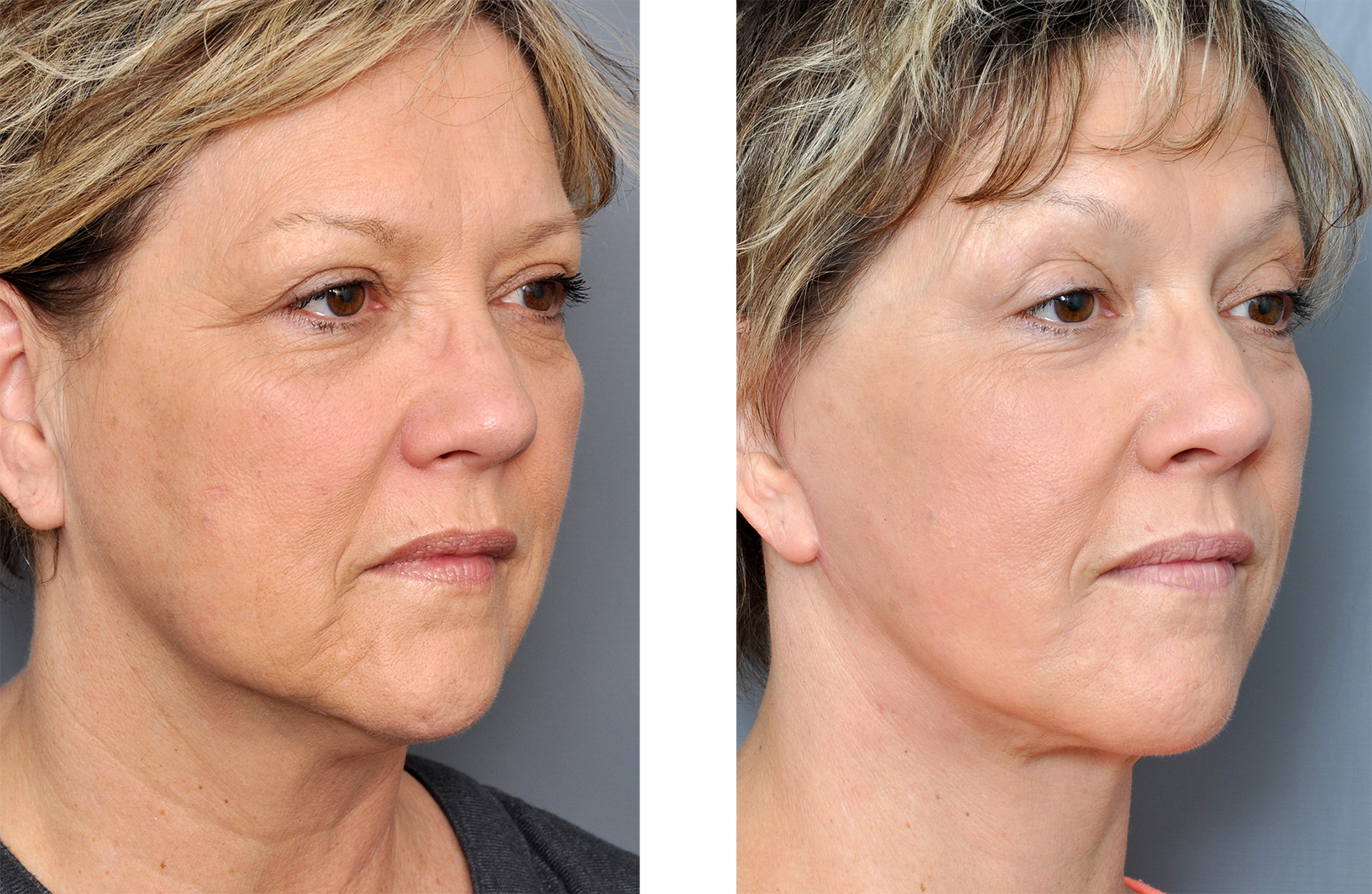Before and after photos of a person's face after a cosmetic procedure, showing reduced wrinkles and tighter skin.
