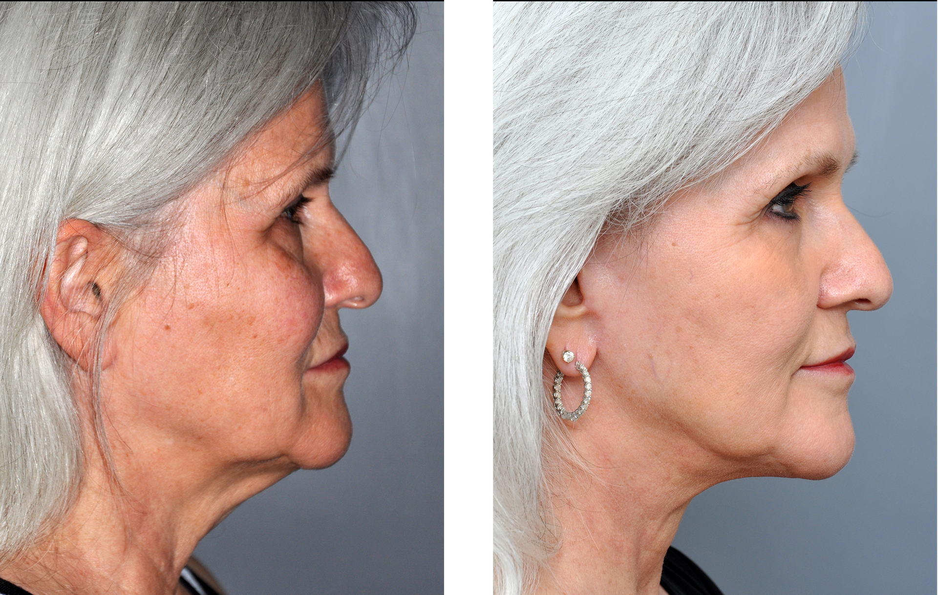 Before-and-after profile view: woman's face, neck lift. Left side sagging skin; right side improved skin tone.