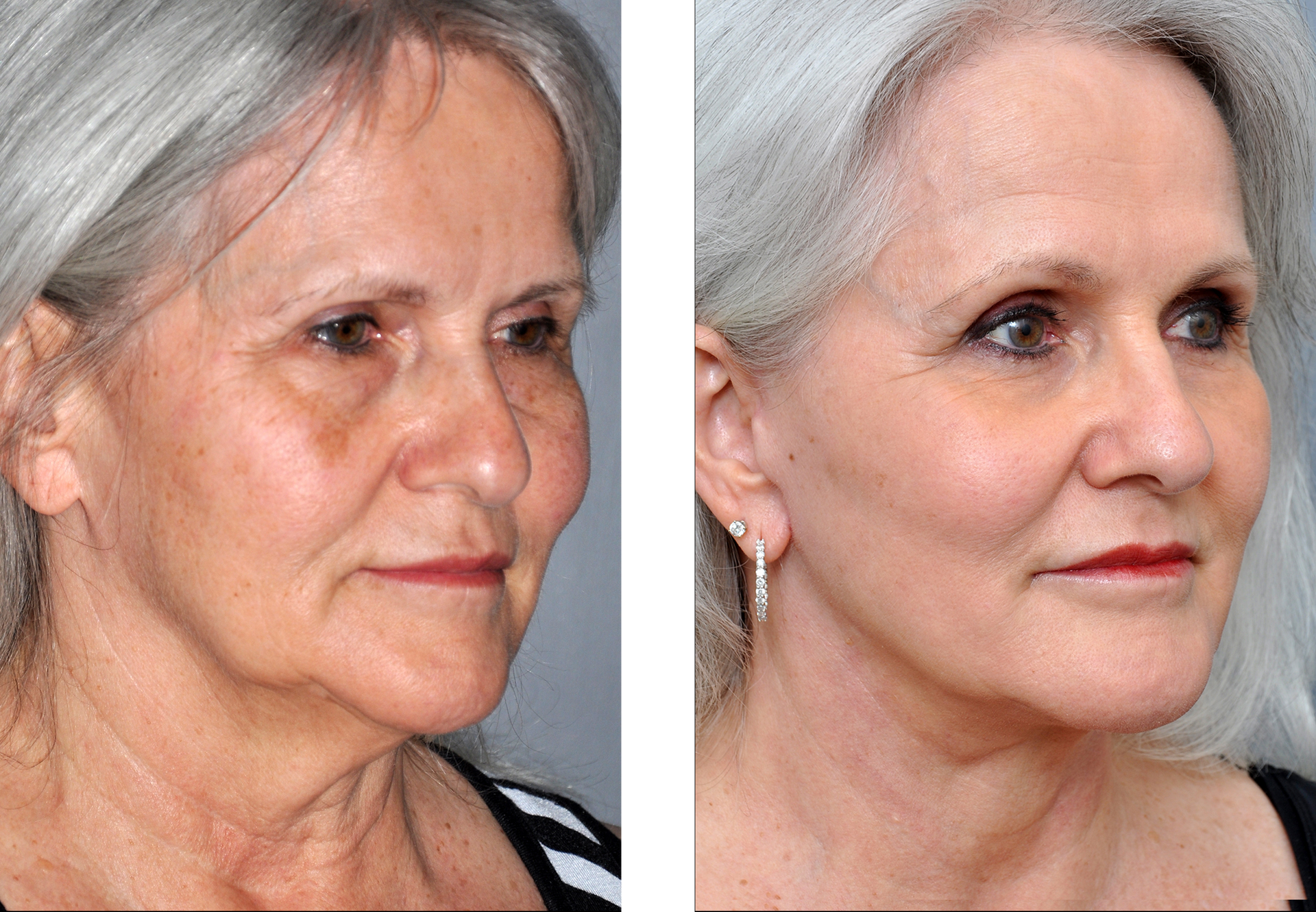 Before and after photos showing a woman's face, highlighting facial lift results.