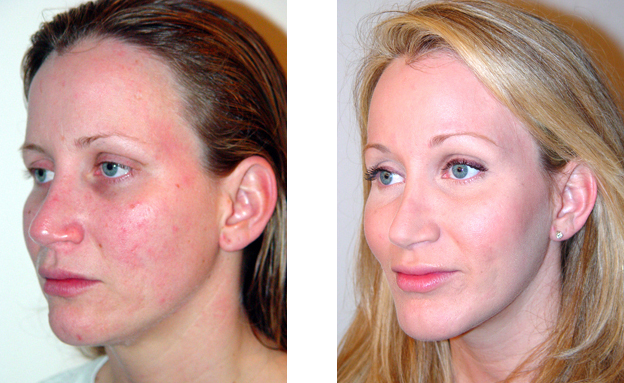 Woman's face before and after treatment, showing reduction in redness and improved skin appearance.