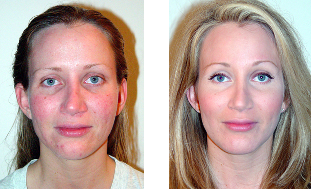 Side-by-side comparison of a person's face. Left side: redness. Right side: smoother complexion, makeup.