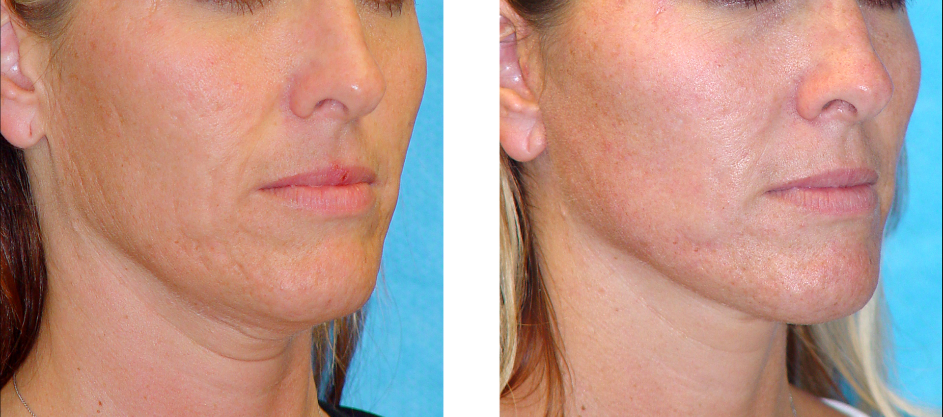 Side-by-side comparison of a person's face before and after a skin treatment, showing reduced skin discoloration.