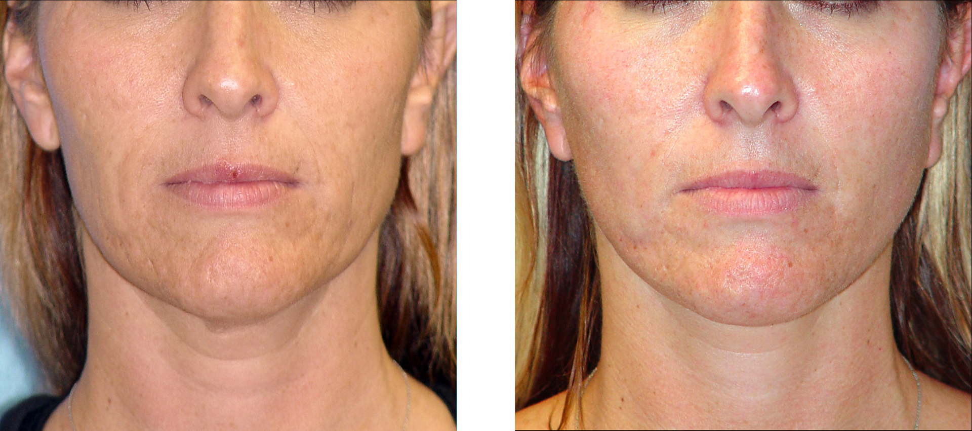 Before and after of a woman's face, showing improvement of skin texture after a procedure.