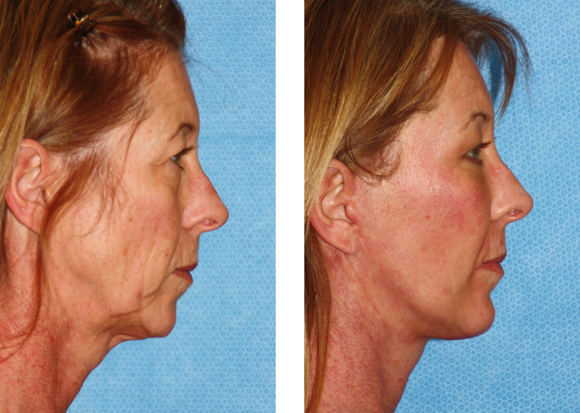 Before-and-after of a person's profile; loose skin on the left, taut skin on the right.