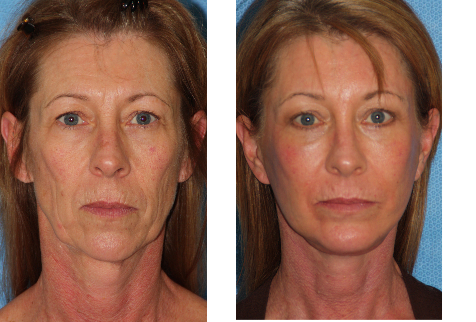 Before-and-after facial surgery comparison: woman's face shows reduced wrinkles and tightened skin.