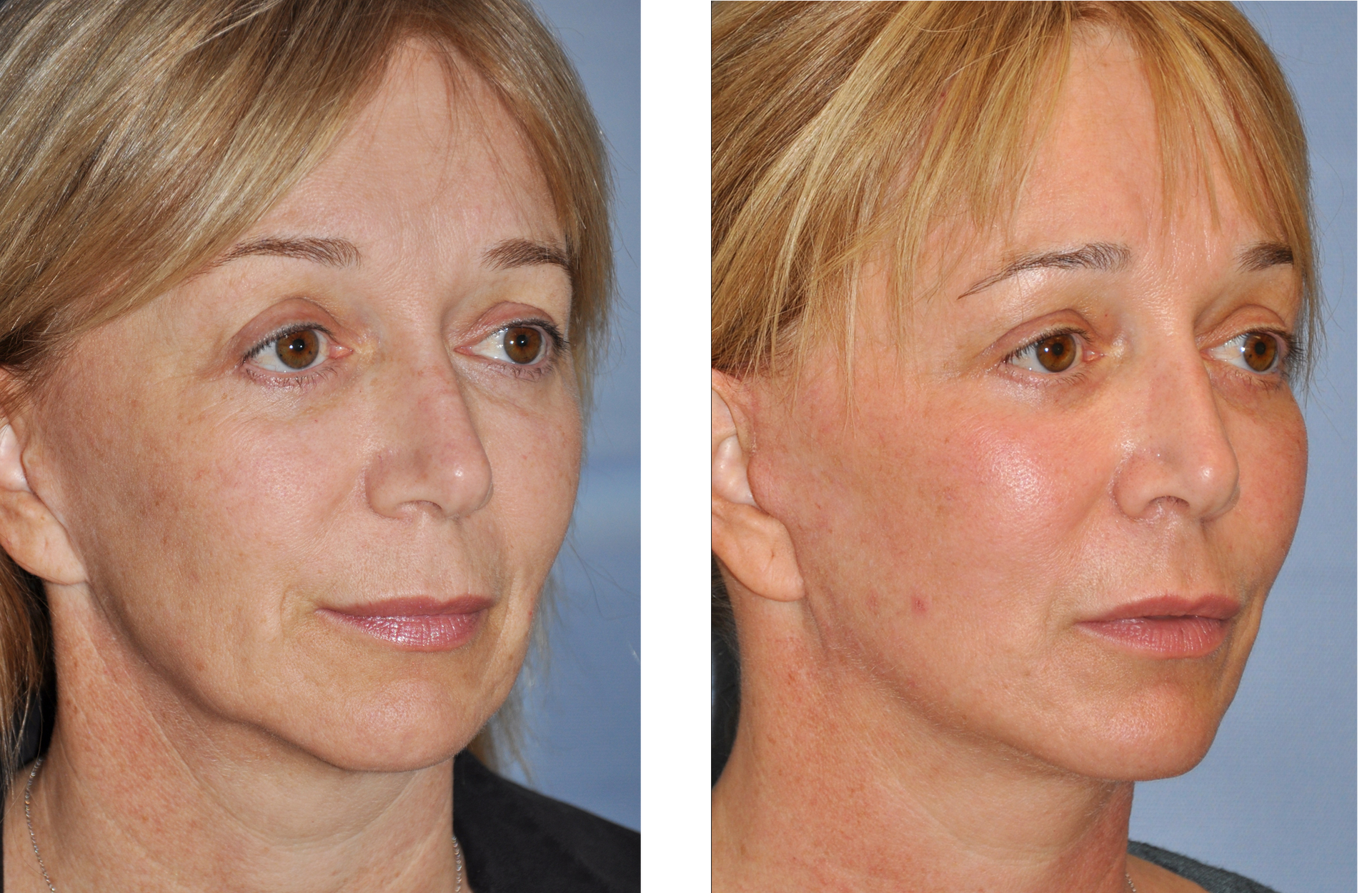 Before-and-after facial surgery comparison: woman, visible wrinkles reduced, skin smoother, with improved jawline definition.