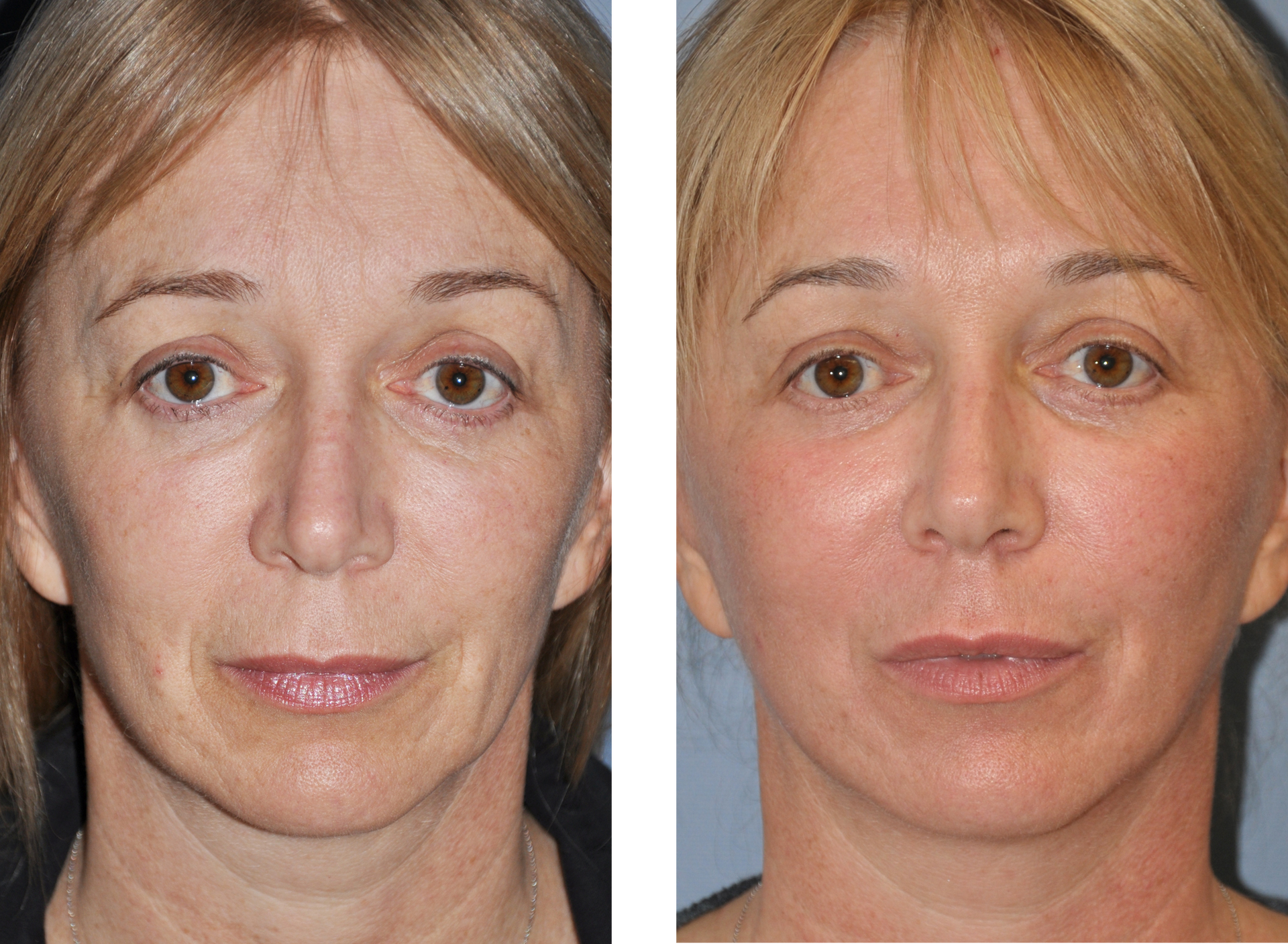 Face lift before and after. Wrinkled face on the left, smoother on the right, same woman.