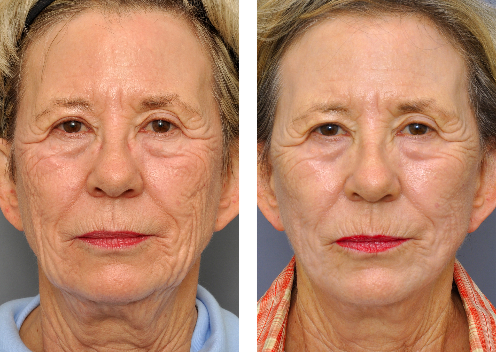 Williamson Cosmetic Center - facial rejuvenation gallery