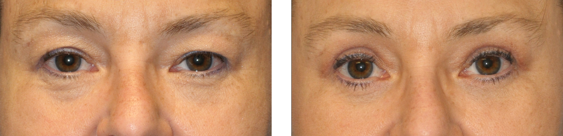 Comparison of eyes before and after an apparent cosmetic procedure.