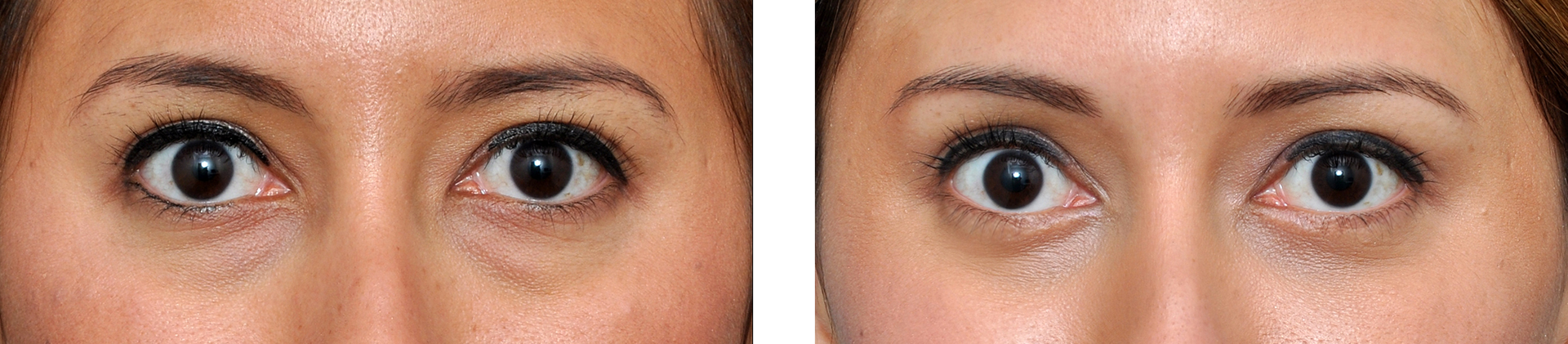 Before and after close-up of a person's eyes, showing a cosmetic eye procedure. The left side is before, right side after.