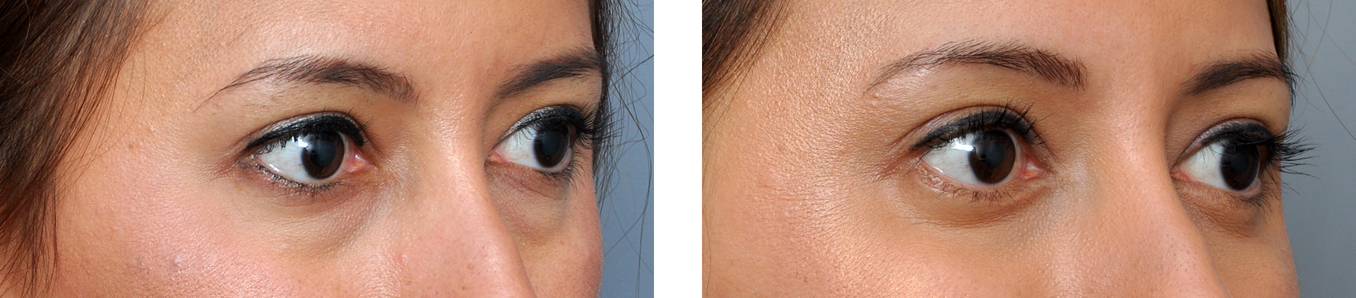 Comparison of woman's eyes before and after an eye lift procedure, with less puffiness in the after photo.