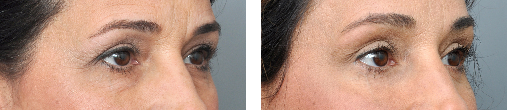 Before and after comparison of a person's eyes, showing a reduction of wrinkles.