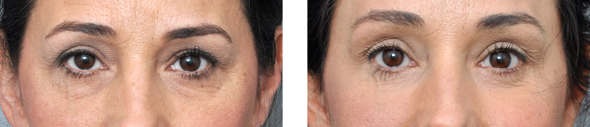 Two close-up photos of a person's eyes, one before and after a possible cosmetic procedure.
