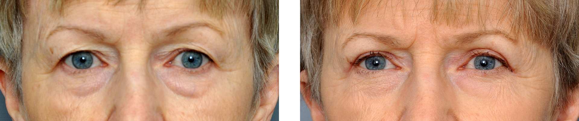 Two side-by-side images of a person's eyes before and after an eyelid lift.