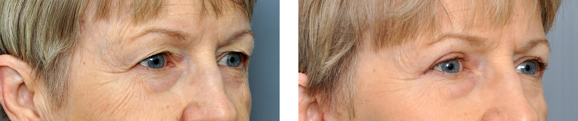 Side-by-side comparison of an eye area before and after a cosmetic procedure.