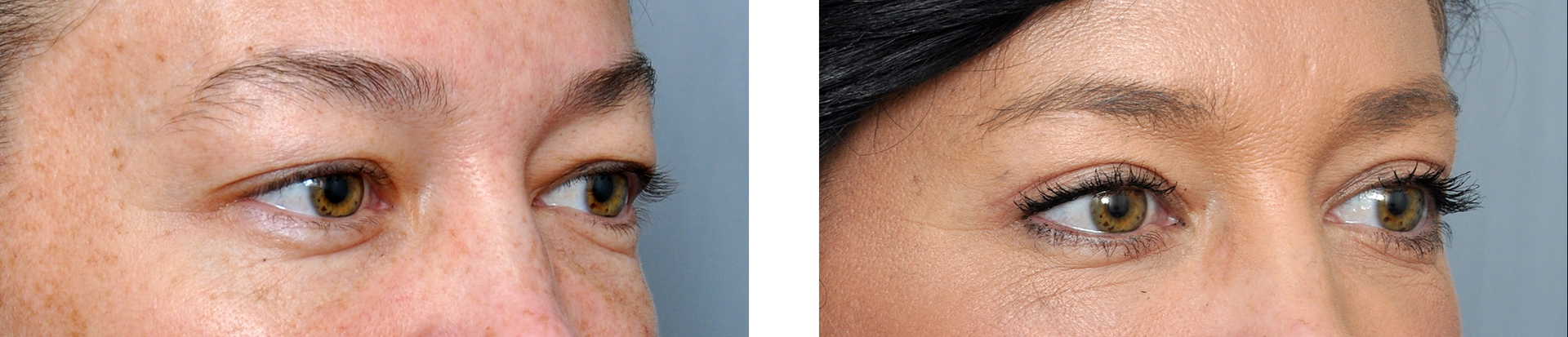 Williamson Cosmetic Center - lower eyelid blepharoplasty gallery