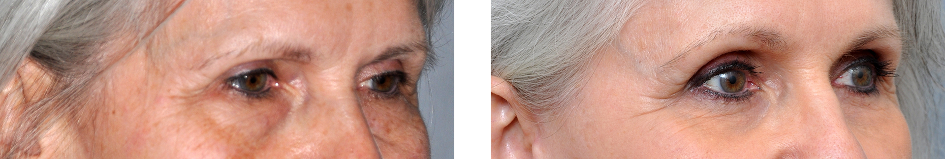 Side-by-side comparison of an eye area. The left side shows wrinkles, while the right side appears smoother.