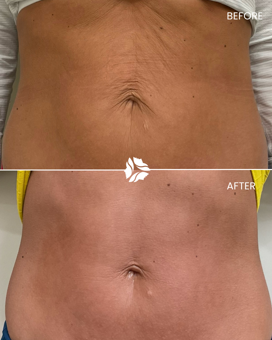 Morpheus8 treatment by Williamson Cosmetic Center & Perenack Aesthetic Surgery Center in Louisiana.