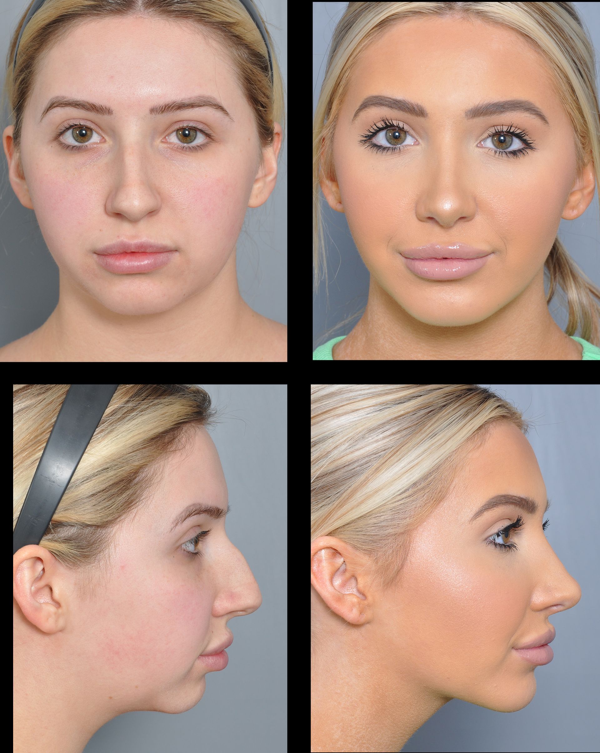 before and after chin implant 