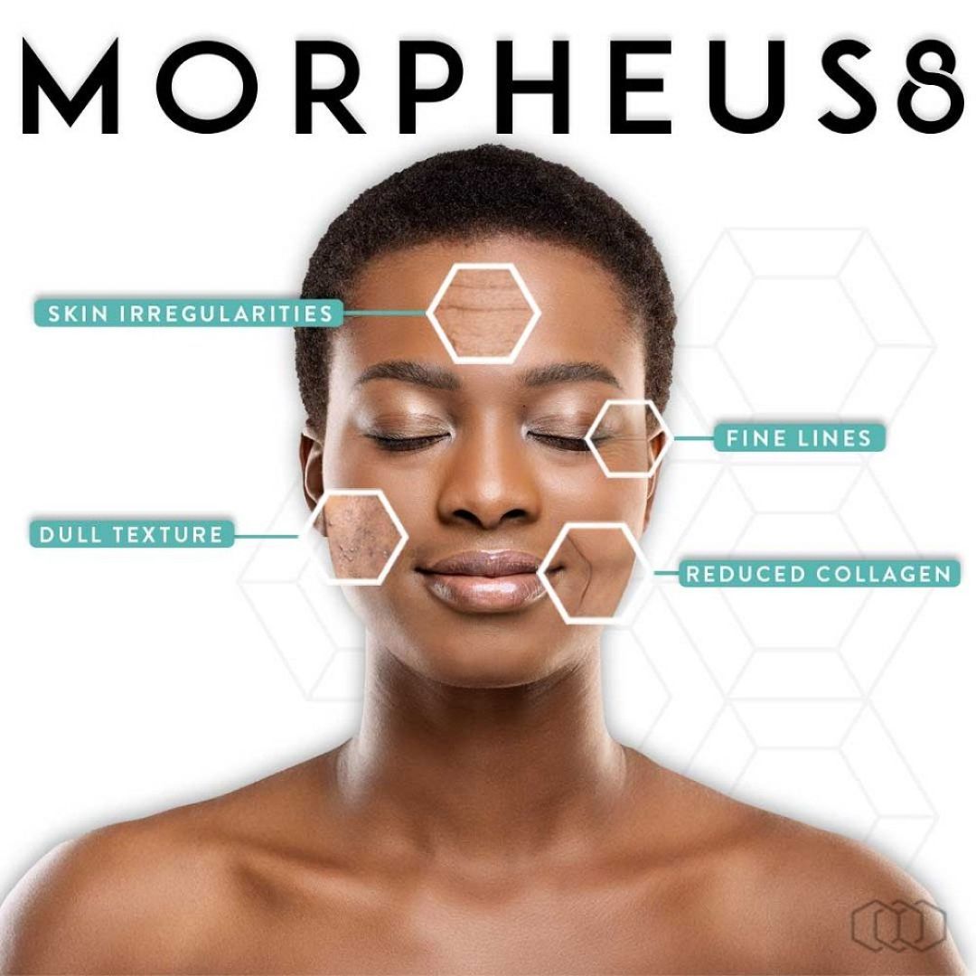 Morpheus8 at Williamson Cosmetic Center