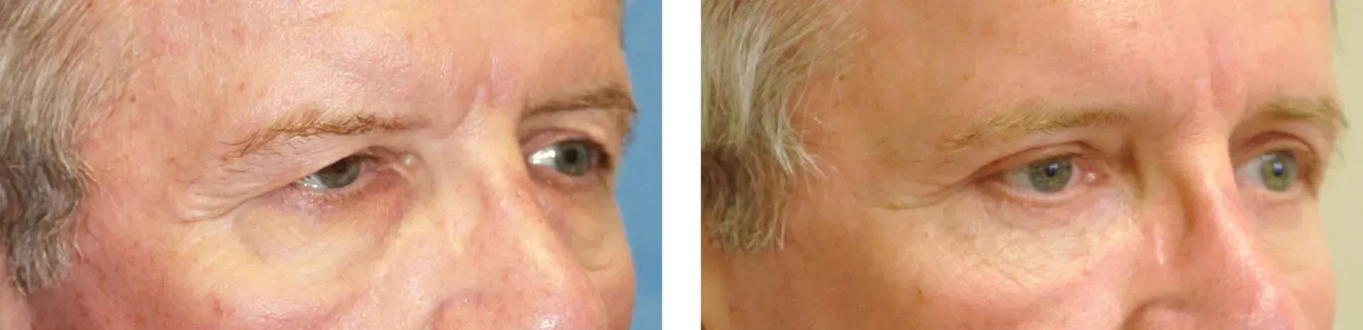 lower blepharoplasty before and after 