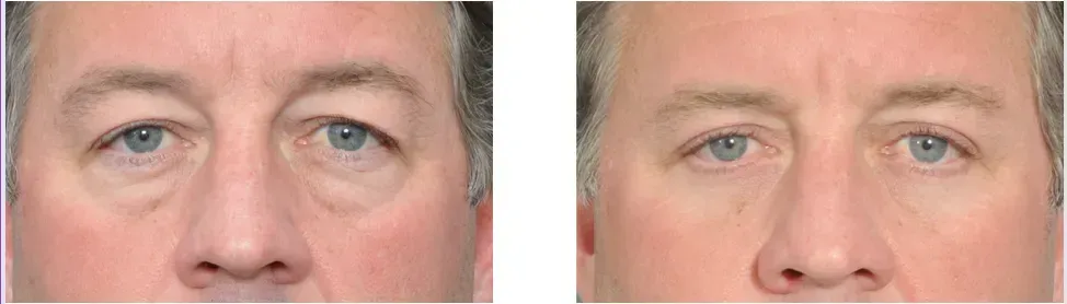 before and after lower blepharoplasty