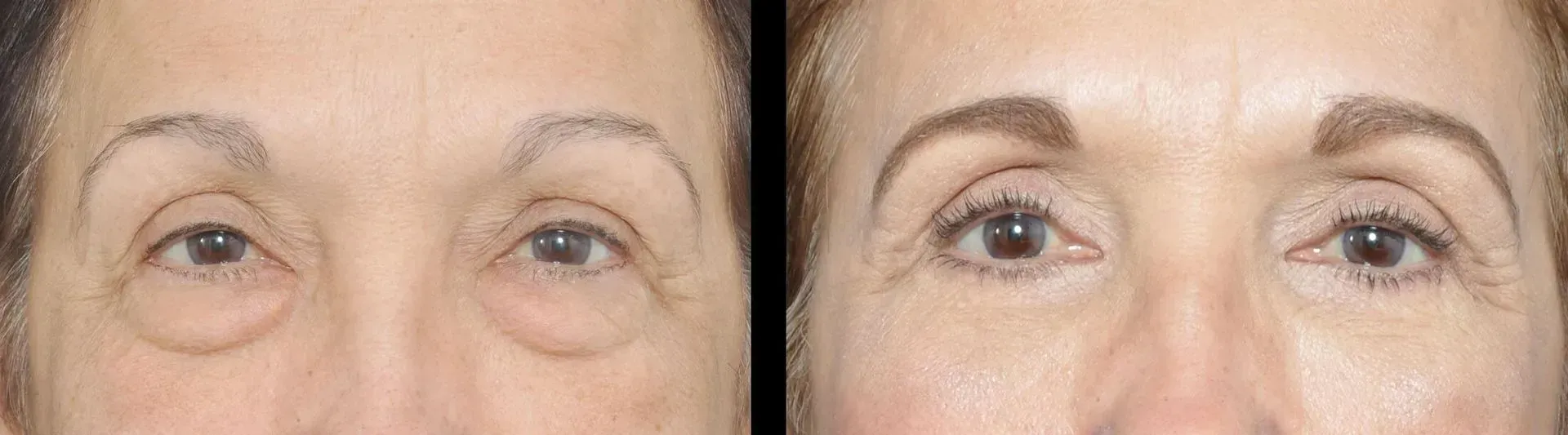 before and after lower blepharoplasty in baton rouge 