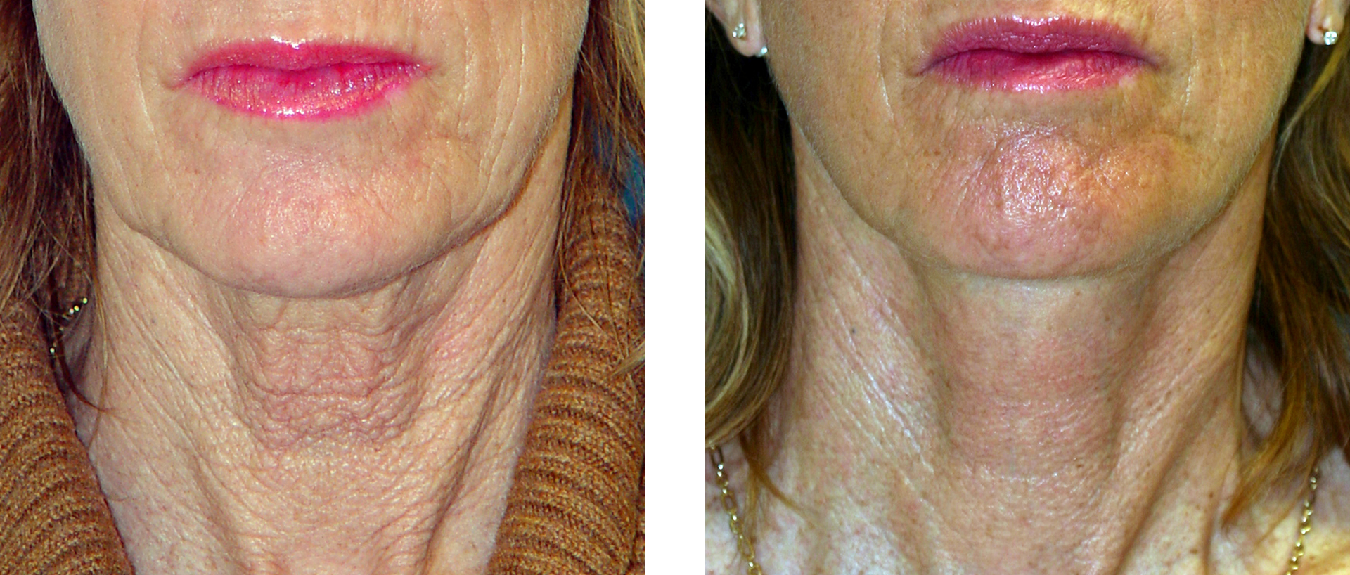 Side-by-side comparison of a person's neck and jawline before and after a cosmetic procedure, showing reduced wrinkles.