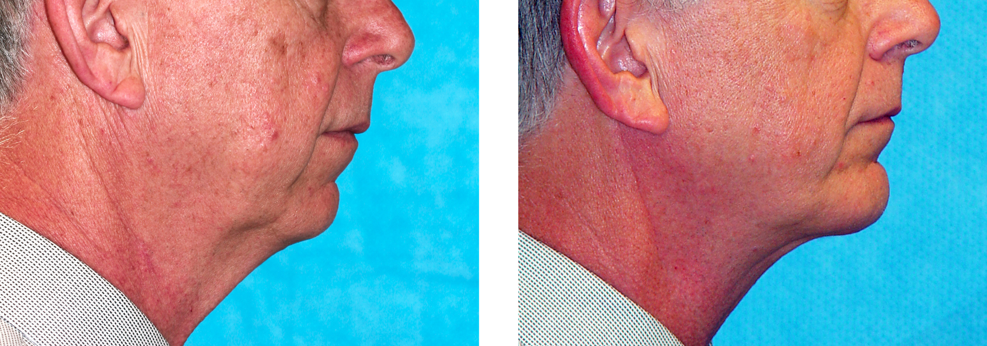 Comparison of a person's profile before and after a cosmetic procedure, showing a reduction in neck fullness.