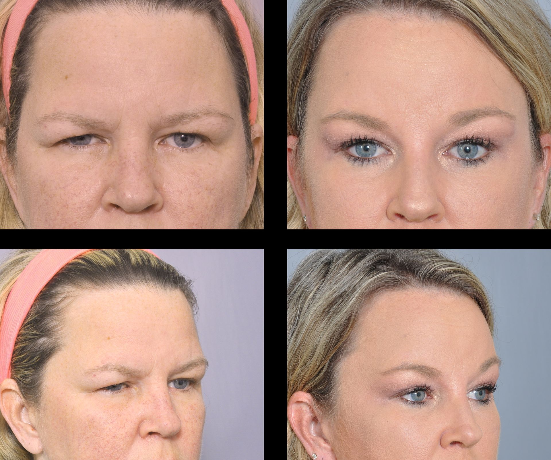 brow lift before and after 