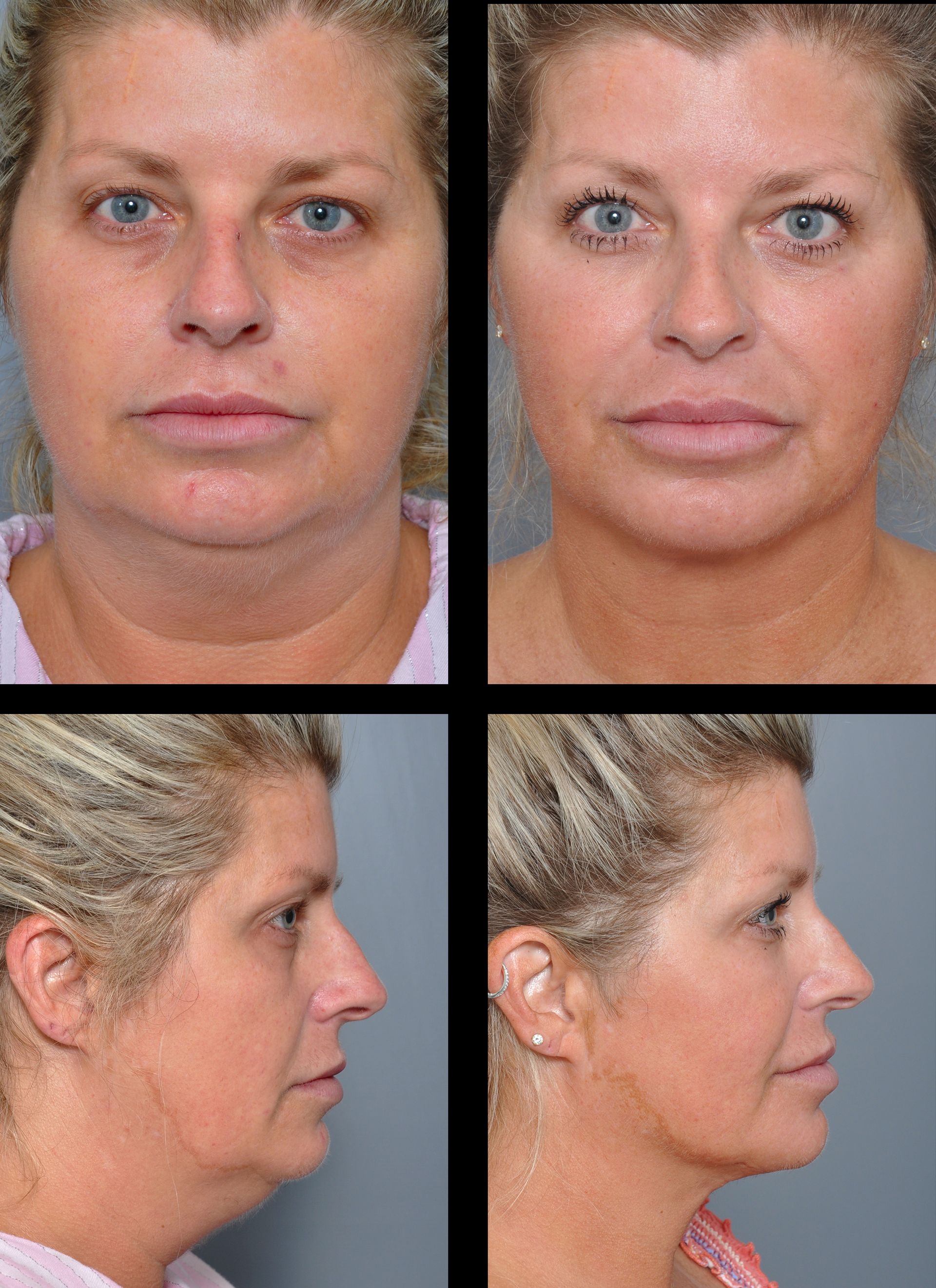 facial liposuction before and after 