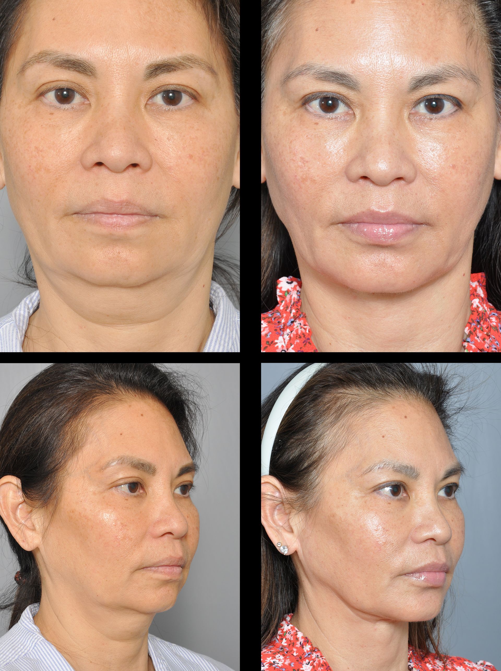 before and after chin implant in baton rouge 