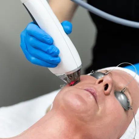 A person receiving a laser facial treatment. A technician wearing blue gloves holds a device near the face.