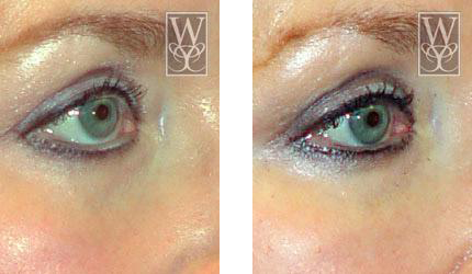 Williamson Cosmetic Center - dermal filler gallery