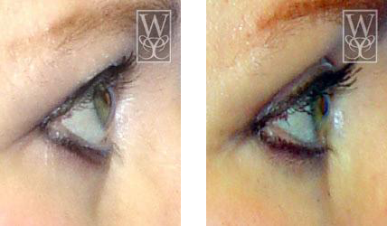 Two side-by-side images of an eye before and after a cosmetic procedure. The eye is surrounded by light skin.