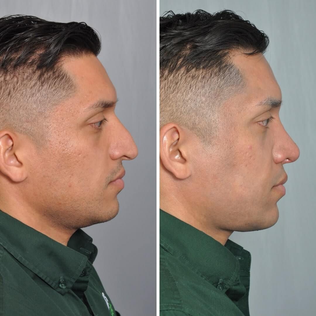 Side-by-side comparison of a man's profile before and after rhinoplasty. The nose is straighter in the after photo.