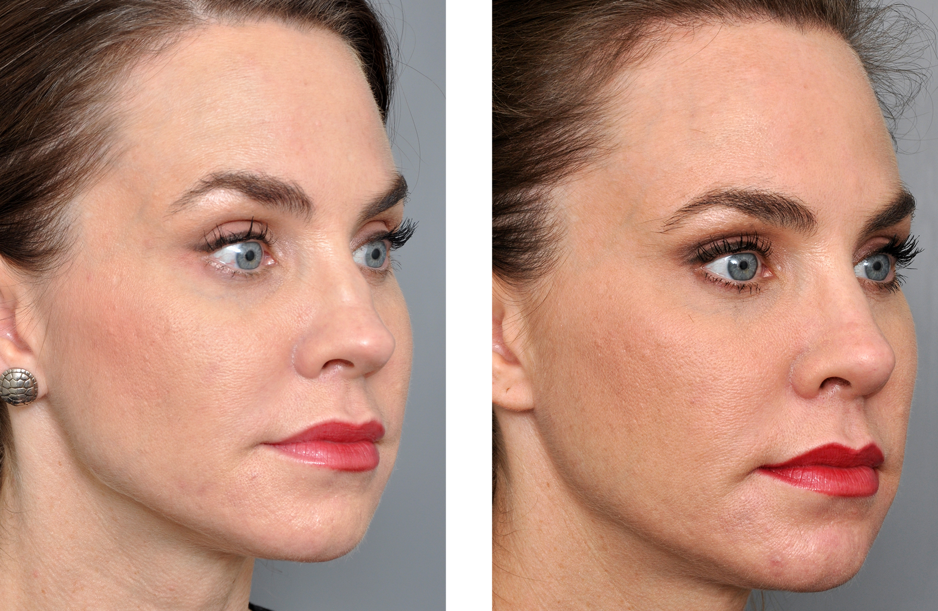 Williamson Cosmetic Center - rhinoplasty gallery