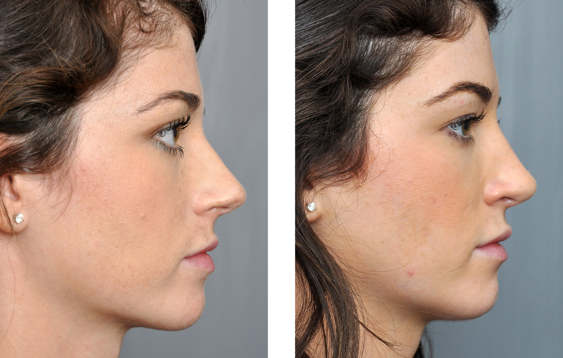 Two side-profile views of a woman's face, before and after a rhinoplasty, showing a changed nose shape.