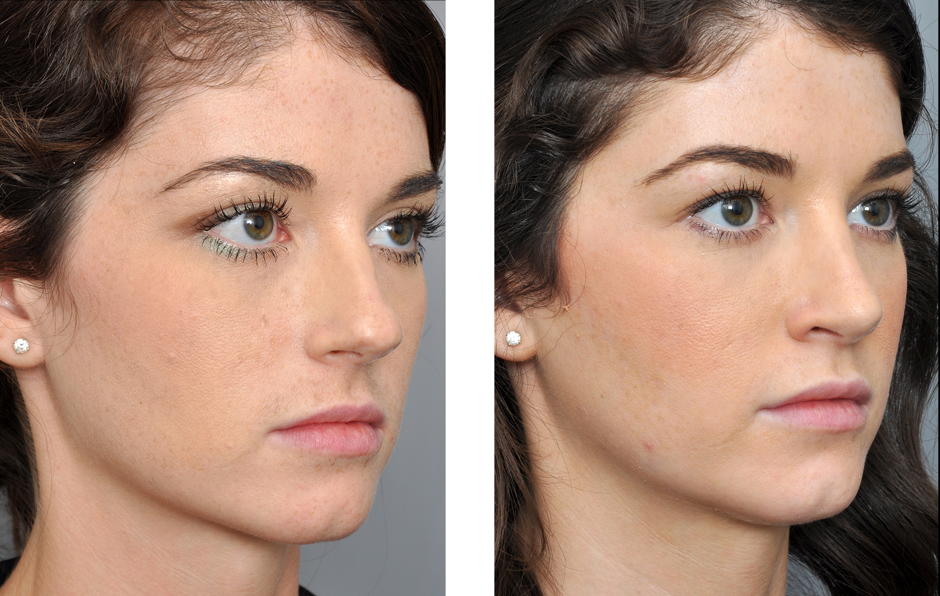 Two side-profile views of a person's face. The right view shows a refined nose and fuller lips.