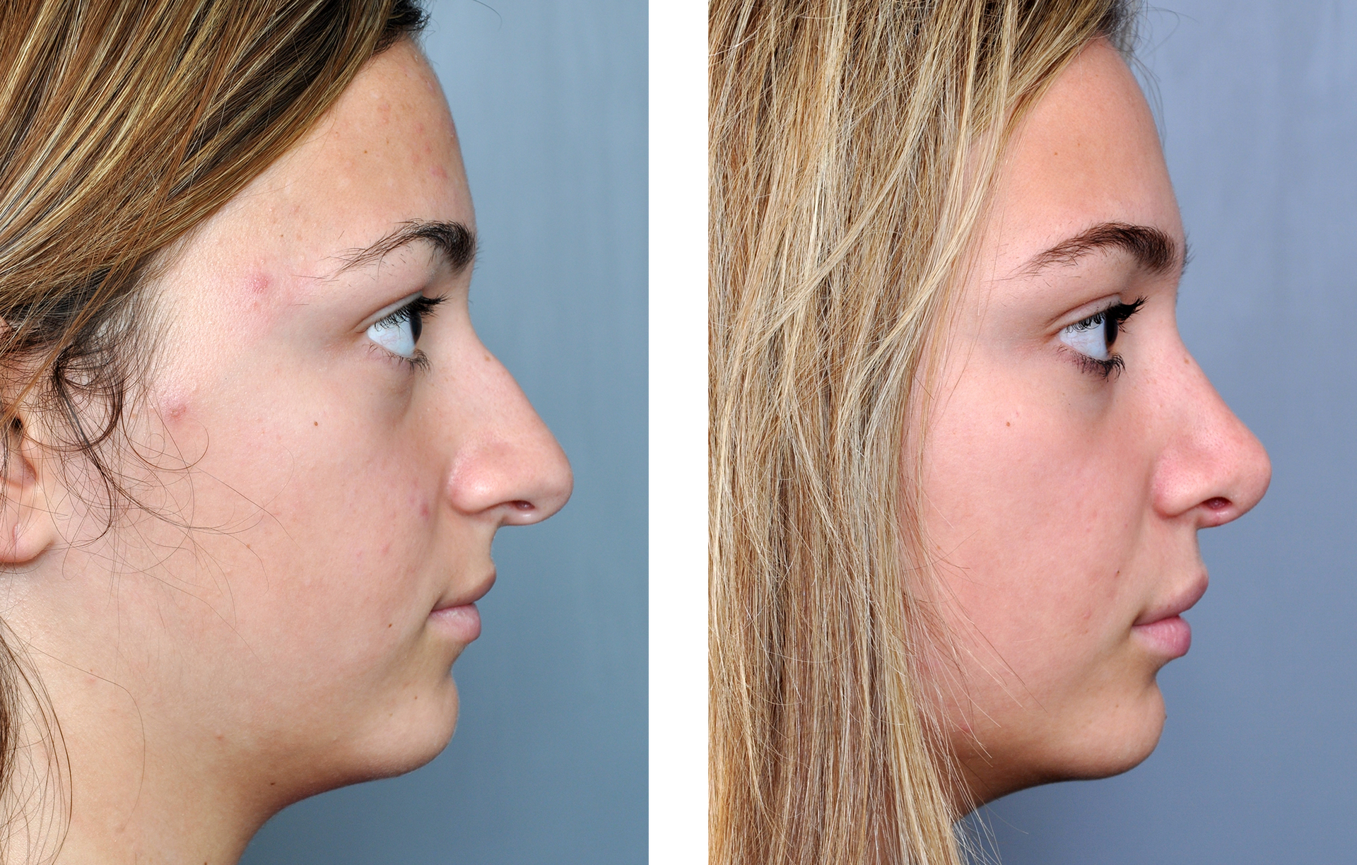 Before and after profile views of a nose reshaping surgery.